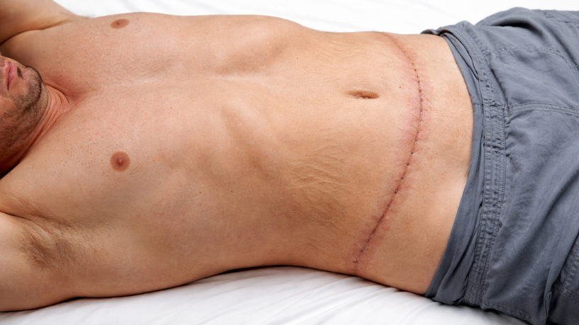 Reposicionamento dos tecidos na abdominoplastia explicado por Haeckel Cabral Moraes.